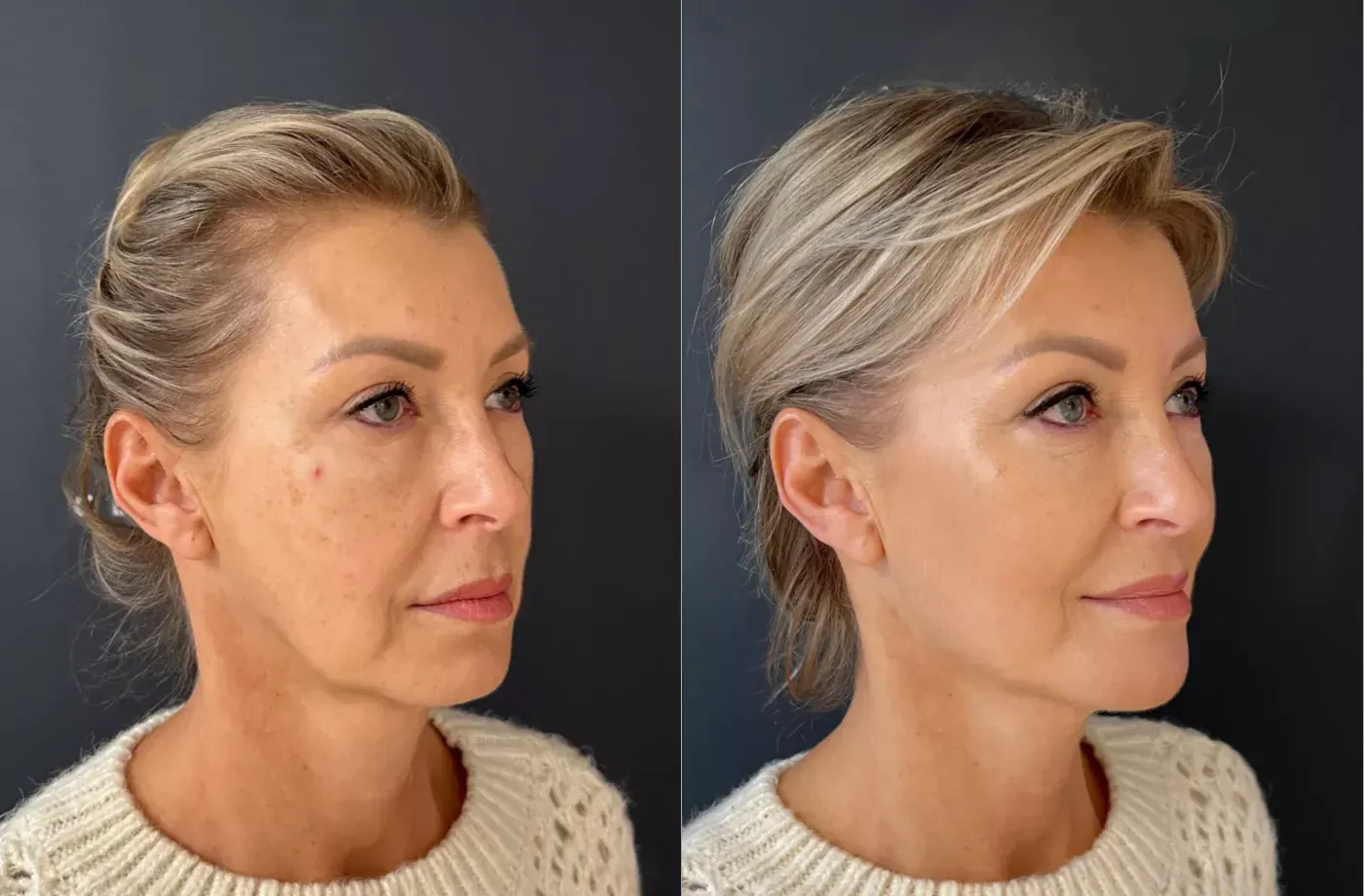 Iris — voor en na fillers