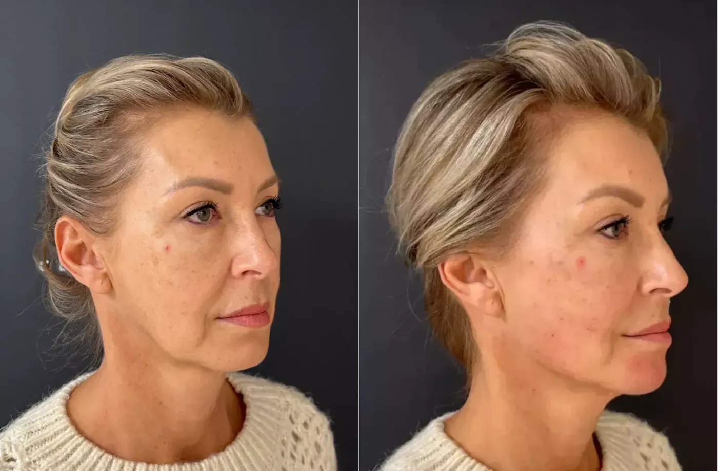Iris — voor en na fillers