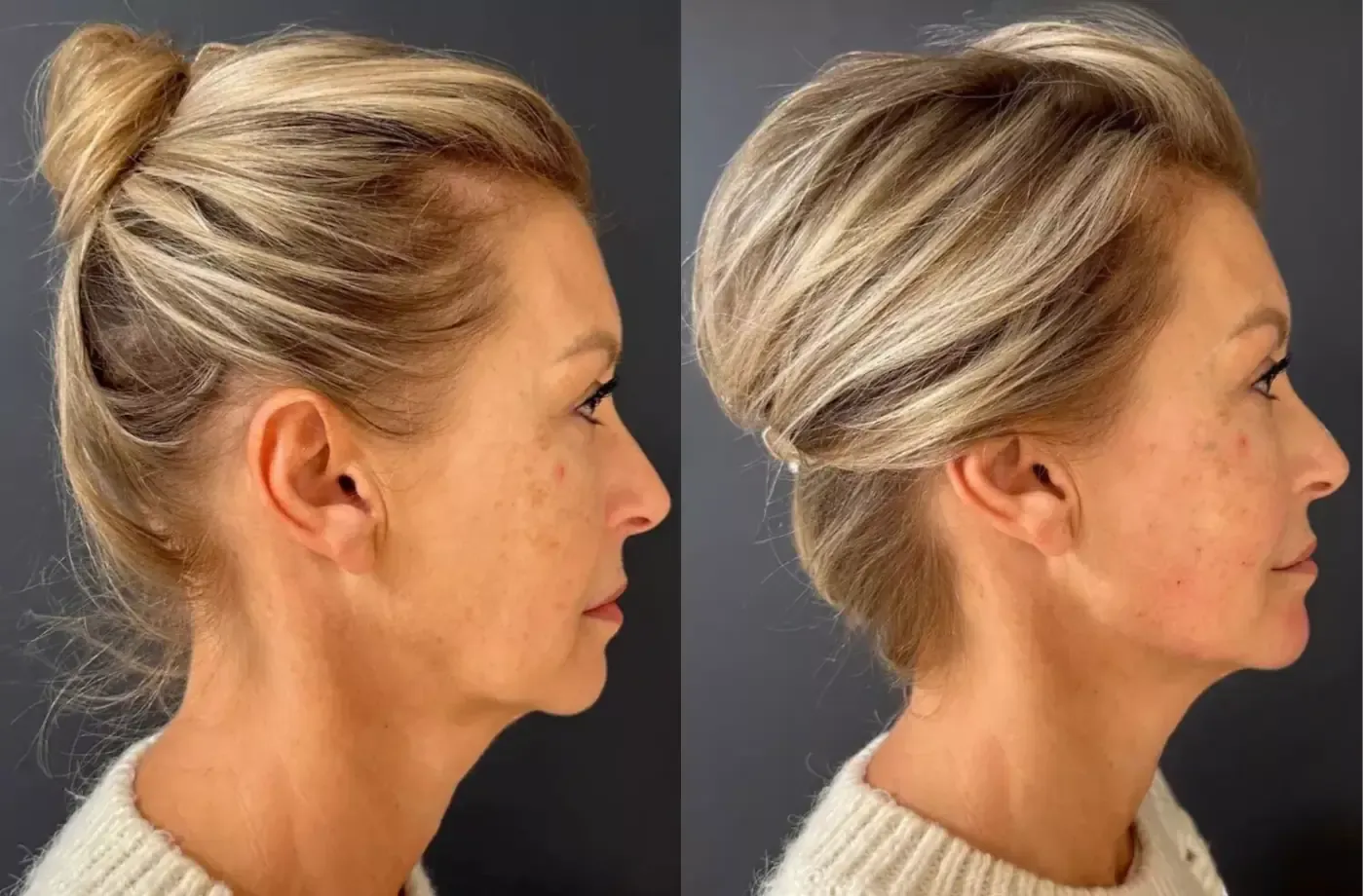 Iris — voor en na fillers