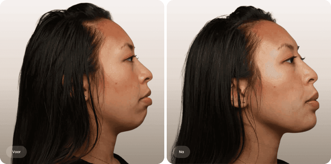 Evelien — voor en na fillers