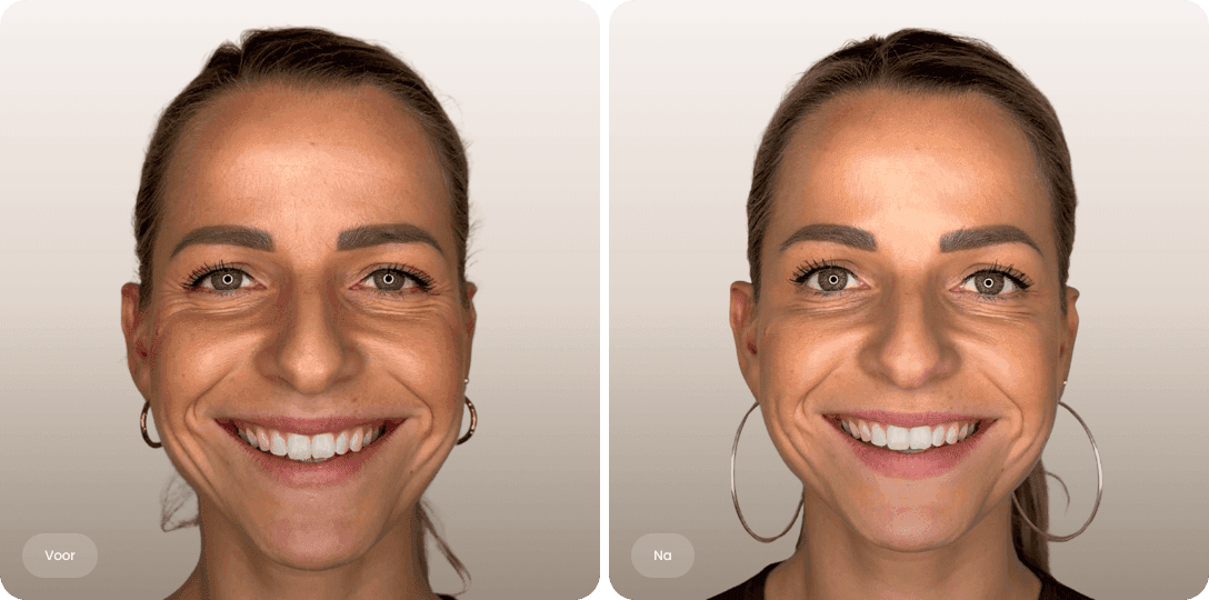Joke — voor en na botox